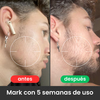 2 Bálsamos Adicionales Apolo Ultra Potente con Minoxidil 20%