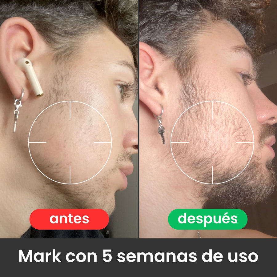 2 Bálsamos Adicionales Apolo Ultra Potente con Minoxidil 20%