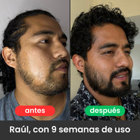 2 Bálsamos Adicionales Apolo Ultra Potente con Minoxidil 20%
