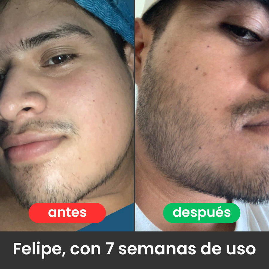 2 Bálsamos Adicionales Apolo Ultra Potente con Minoxidil 20%